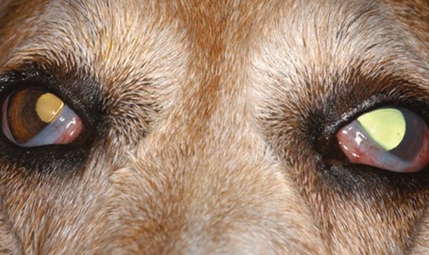 glaucoma